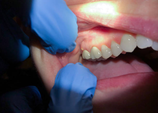 Best Emergency Broken Tooth Repair in Somerset, OH