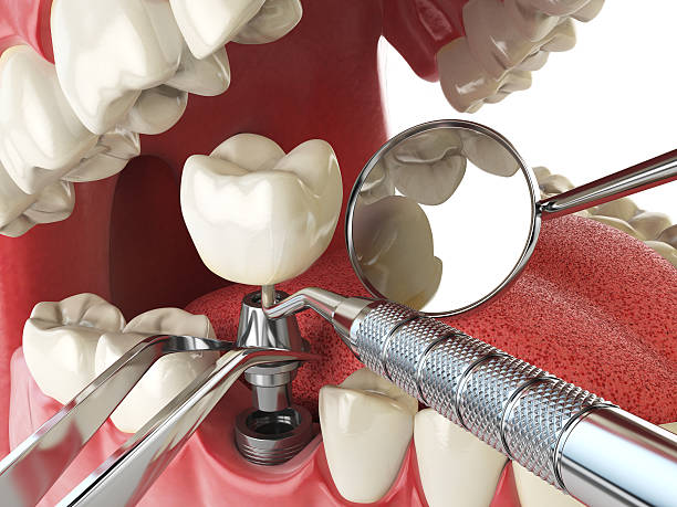 Best Emergency Tooth Extraction in Somerset, OH
